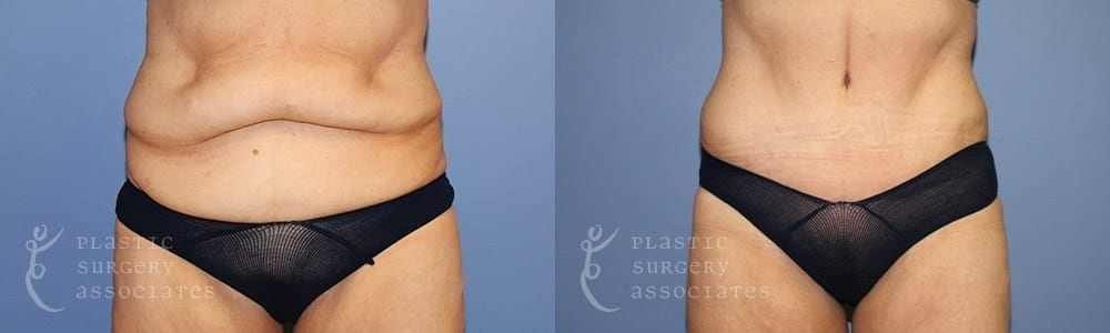Patient 2 Tummy Tuck Before and After