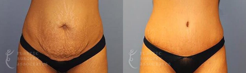 Patient 3a Tummy Tuck Before and After