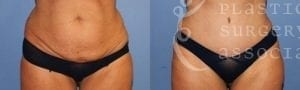 Patient 5a Tummy Tuck Before and After