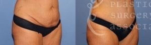Patient 5b Tummy Tuck Before and After