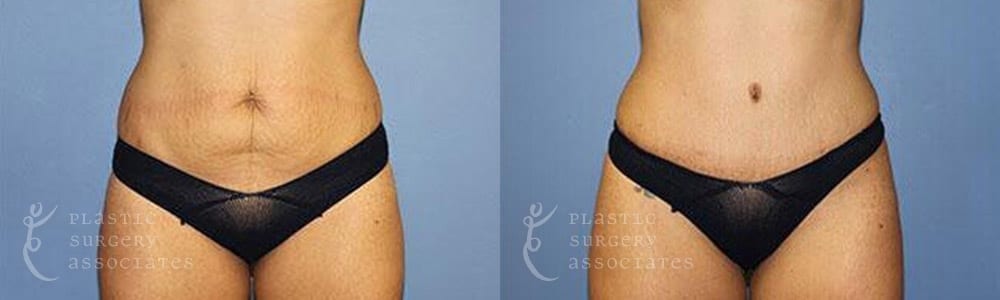 Patient 7a Tummy Tuck Before and After