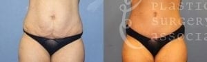 Patient 8a Tummy Tuck Before and After