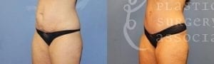 Patient 8b Tummy Tuck Before and After