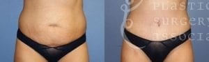 Patient 9a Tummy Tuck Before and After